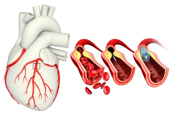 Coronary Artery Disease